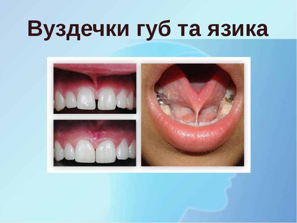Вуздечки губ та язика