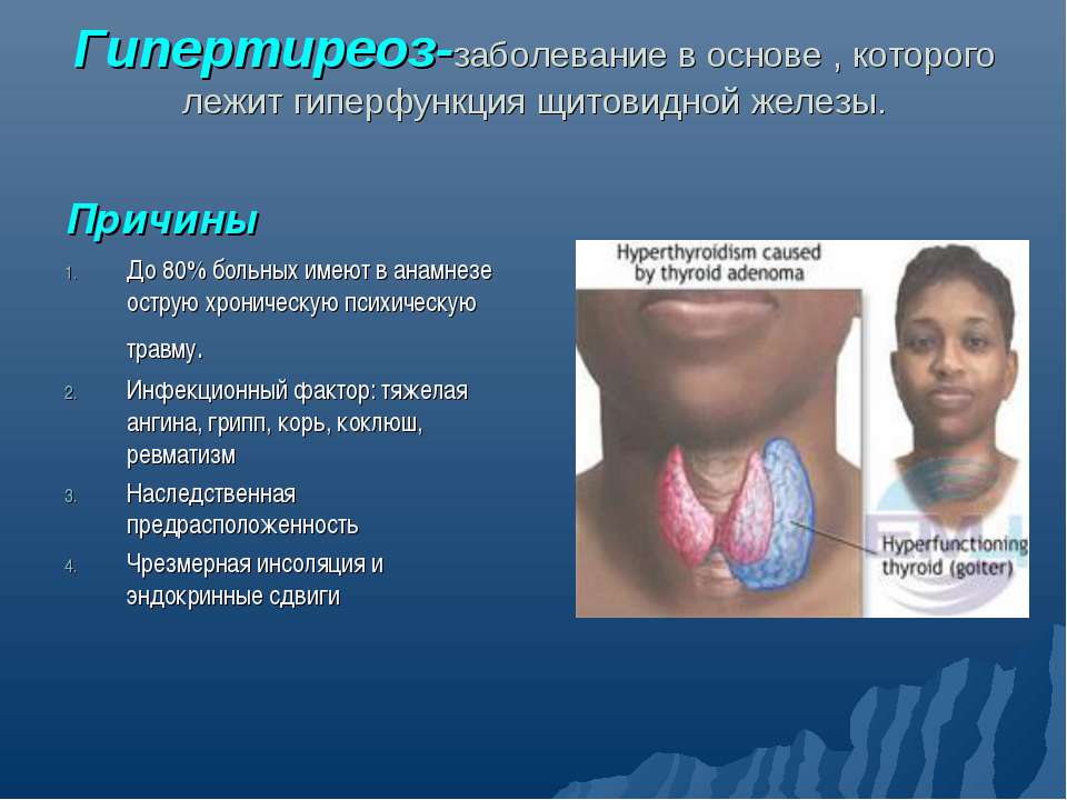 Гипертиреоз