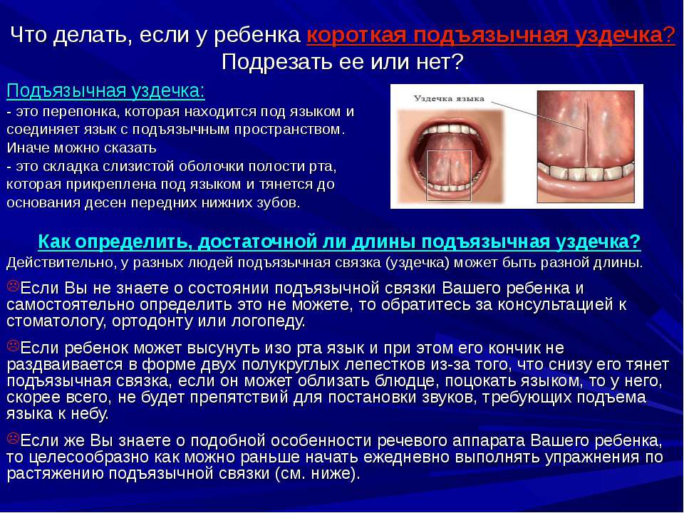 Что делать, если у ребенка короткая подъязычная уздечка?
