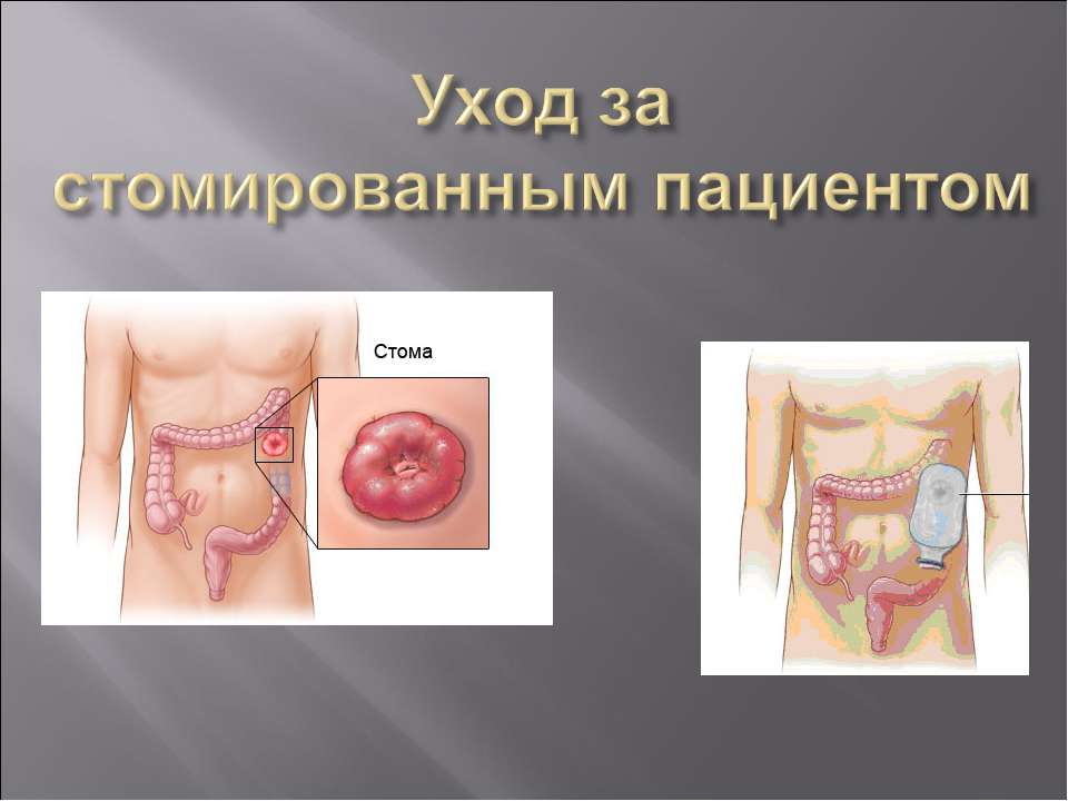 Уход за стомированным пациентом